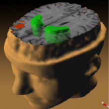 A PET scan, illustrating of Schizophrenia's effect on the brain