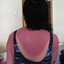 Sun Burn