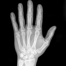 X ray of hand