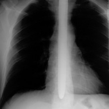 X-Ray of Dan Meyer showing sword swallowing in action