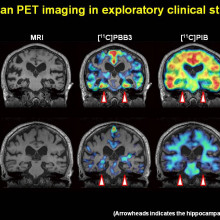 Alzheimer's brain