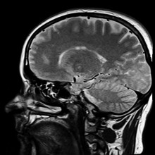 BRAIN Brain