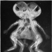 X-ray of joined twins, cephalothoracopagus.