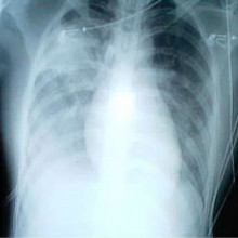 SARS X-ray appearance