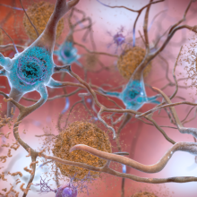 Alzheimer neuron