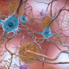 Cartoon of nerve cells (neurones) affected by Alzheimer's Disease with beta-amyloid plaques and neurofibrillary tangles