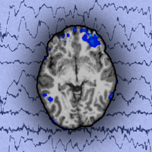 Epilepsy causes cyclooxygenase-mediated vasoconstriction leading to hypoxia in the cerebral cortex