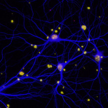 Dementia neuron