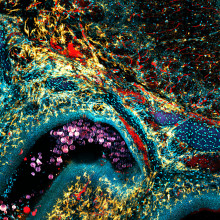 Fungal infection Fungal infection