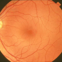 Fundus photograph-normal retina