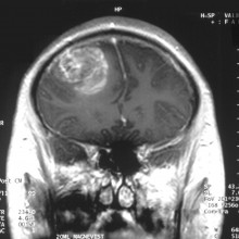 Gliobastoma (astrocytoma) WHO grade IV - MRI coronal view, post contrast. 15 year old boy.