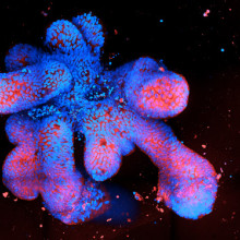 Crohn's organoid Crohn's organoid