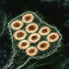 Measles virus