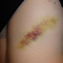 Yellow bruise on leg