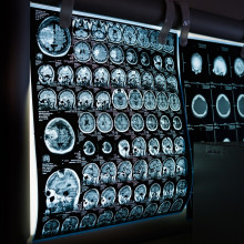 MRI scans