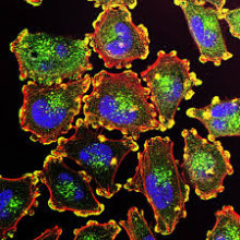 Melanoma tumour cells