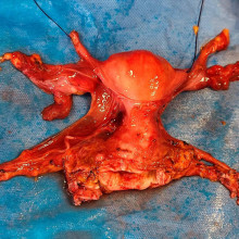 Explanted uterus Explanted uterus