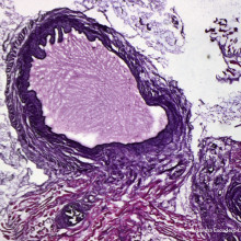 A mouse model of endometriosis, characterised by cyst formation