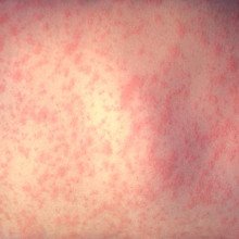 A stomach displaying a measles rash.