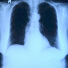 radiograph of the chest