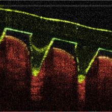 Microneedles pierce skin painlessly to deliver drugs and even remove blood samples for analysis.