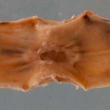 Barrett's oesophagus with adenocarcinoma