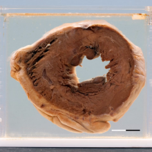 Normal heart midventricular transverse section