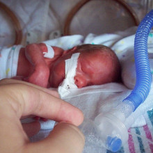 A premature baby