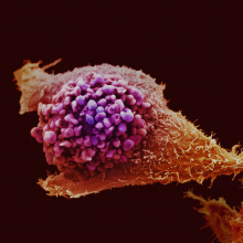 Prostate cancer cell imaged using electron microscopy and coloured artificially