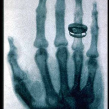 Roentgen's X-ray picture of the hand of Alfred von Kolliker, taken 23 January 1896