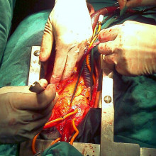 Human heart seen in a cardiac surgery operating room