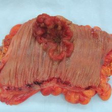 Appearance of the inside of the colon showing one invasive colorectal carcinoma (the crater-like, reddish, irregularly shaped tumor).