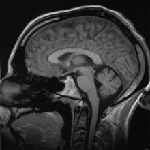 Saggital transection through the human brain