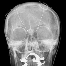 Deep brain stimulation - probes shown in X-ray of the skull (white areas around maxilla and mandible represent metal dentures and are unrelated to DBS devices)