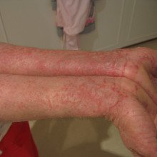 Eczema on arms