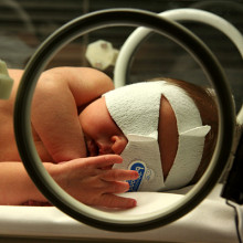 newborn infant undergoing phototherapy to treat neonatal jaundice