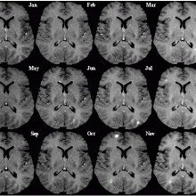 Multiple Sclerosis: T1-weighted MRI (post-contrast) of same brain slice at monthly intervals. Bright spots within the brain tissue indicate active lesions.