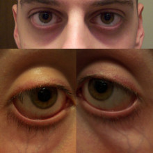  These photographs (all taken at the same time, of the same 19 year old, caucasian male) serve as examples of periorbital darkness, periorbital puffiness, pronounced vein visibility, and shadowing due to sunken eye sockets. It should also be noted...