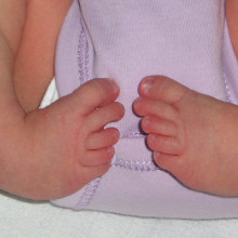 A child with club foot