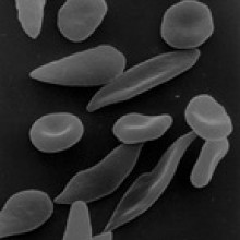 Sickled red blood cells in a patient with sickle cell anaemia