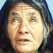 Bilateral cataract in an Afghan woman (pupils dilated)