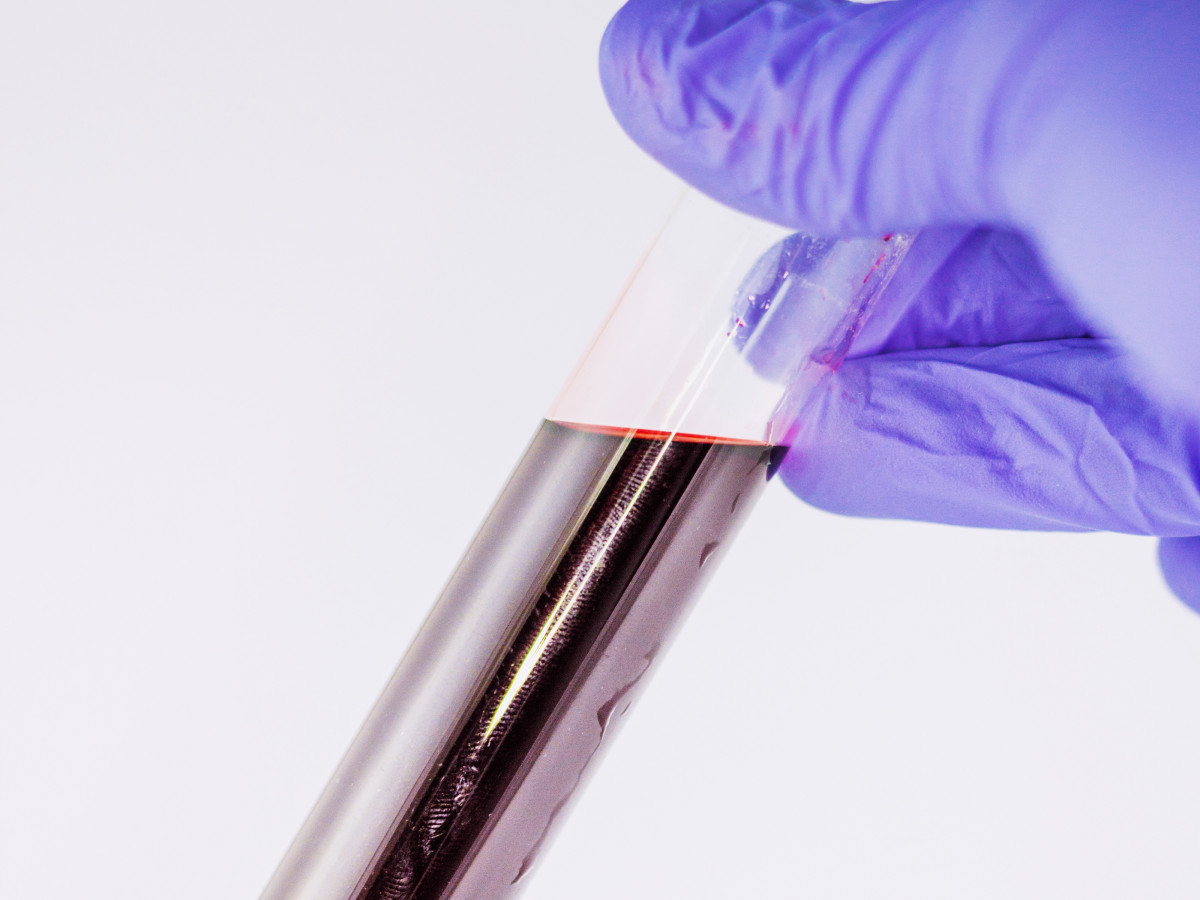 Can blood group affect Covid-19 risk? | Podcasts | Naked ...
