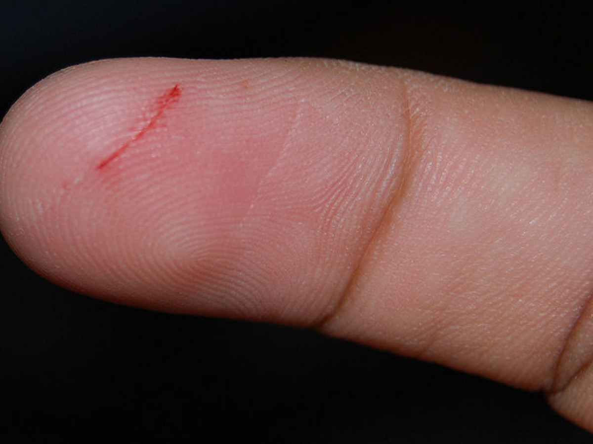 Why Does My Finger Throb After Cut?